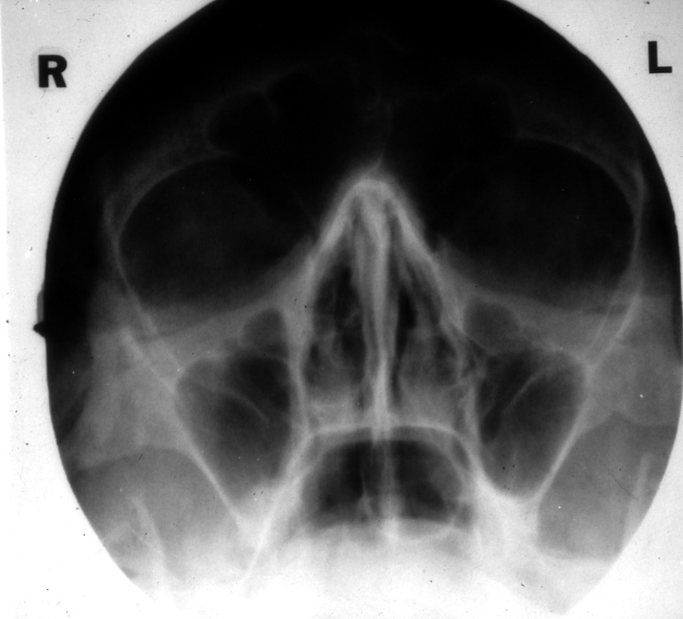 Sinuses x ray positioning