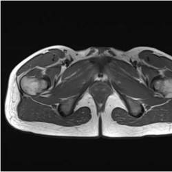 GlutealRegionMRI_01